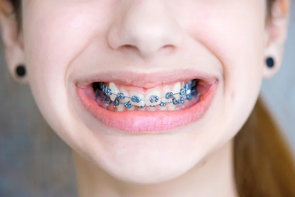 Teeth with braces. — Stock Photo, Image