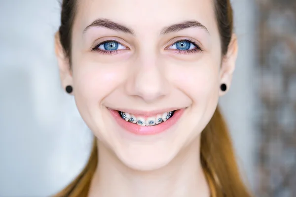 Dentes com aparelho . — Fotografia de Stock