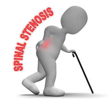 Spinal stenoz temsil eden omurga ağrısı 3d render