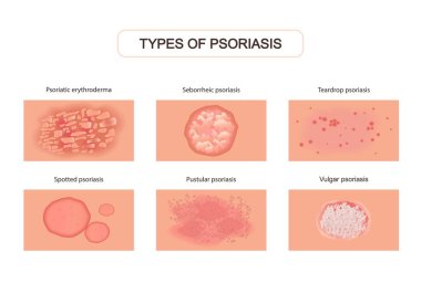 Varieties of psoriasis set. Red eruptions on skin with ulcers and itching damage upper layers of epidermis with allergies severe neurological disease with pustular abscesses. Pathological vector. clipart