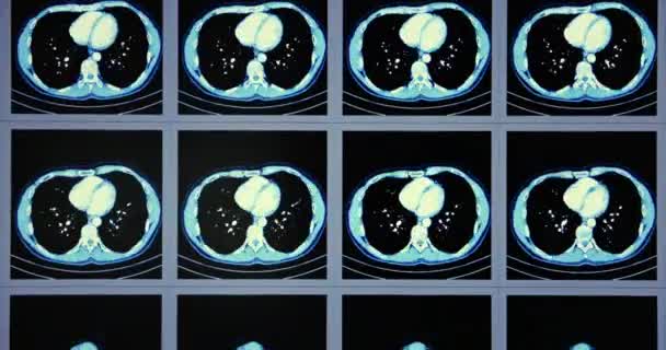 Muitos exames de tomografia computadorizada em movimento da área abdominal inferior e média — Vídeo de Stock