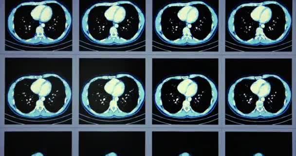 Veel computertomografie scans in beweging van de onder- en middenbuik gebied — Stockvideo