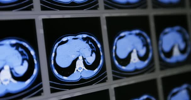 Molte scansioni tomografiche computerizzate in movimento della zona addominale inferiore e media — Video Stock