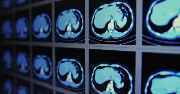 Muchas exploraciones de tomografía computarizada en movimiento de la zona abdominal inferior y media — Vídeo de stock