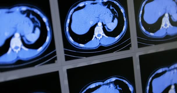 Muchas exploraciones de tomografía computarizada en movimiento de la zona abdominal inferior y media — Vídeos de Stock