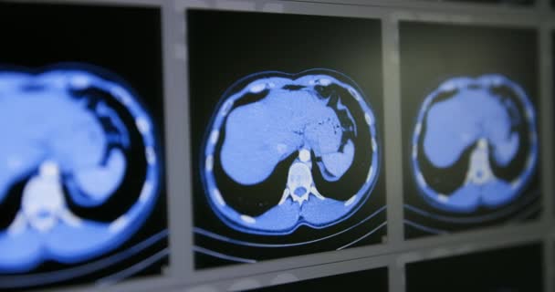 Muchas exploraciones de tomografía computarizada en movimiento de la zona abdominal inferior y media — Vídeo de stock