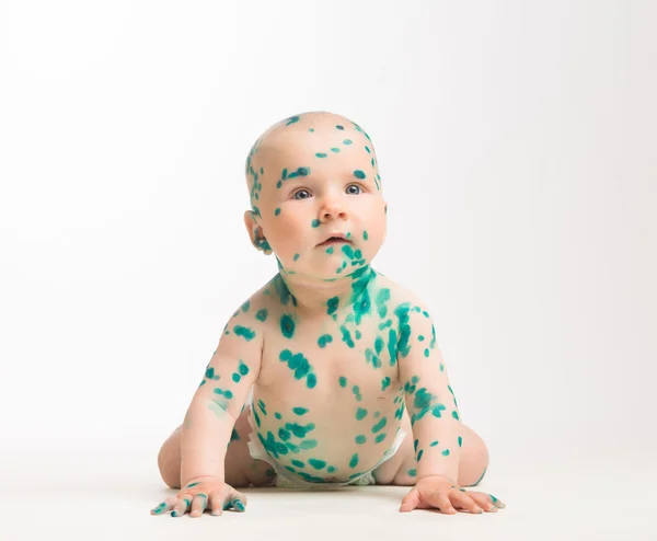 Chicken pox ailing infant on white background — Stock fotografie