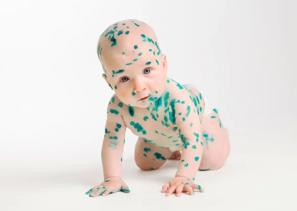 Chicken pox ailing infant on white background