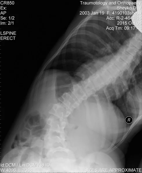 Escoliosis película de rayos X muestran la curvatura de la columna vertebral en paciente adolescente —  Fotos de Stock