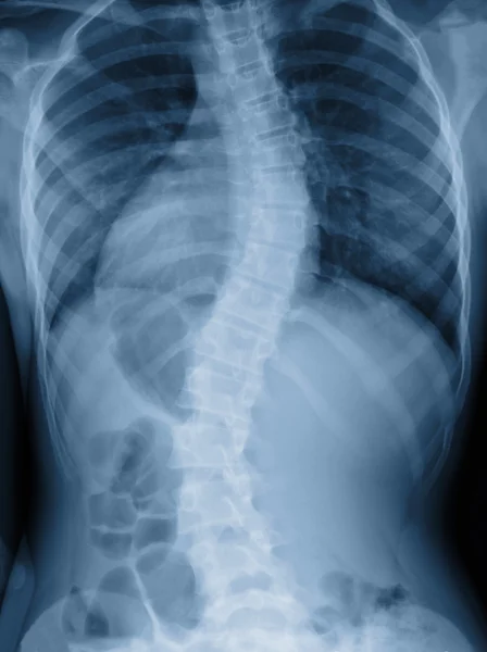 Escoliosis película de rayos X muestran la curvatura de la columna vertebral en paciente adolescente Imagen de stock