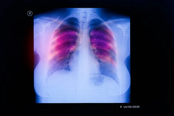 Coronavirus Disease Covid Virus Infection Human Lungs New Corona Virus — Stock Photo, Image