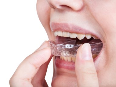Kız aligner ortodontik Düzeltme giderir