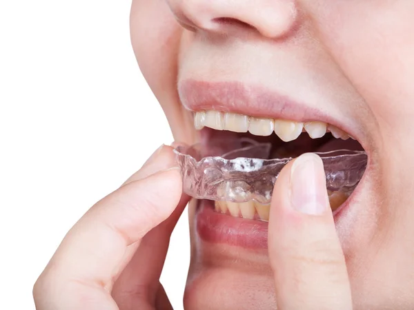 Girl fixes aligner for orthodontic correction — Stock Photo, Image