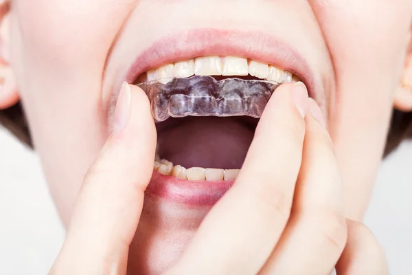 Direct view of young woman fixing clear aligner — Stock Photo, Image