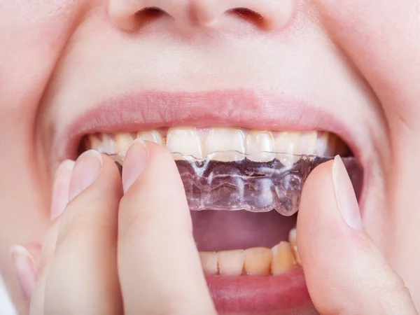 Young woman puts clear aligner close up — Stock Photo, Image