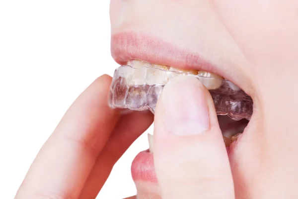 Woman fixes clear aligner on teeth isolated — Stock Photo, Image