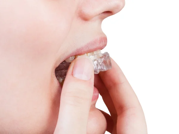 Girl puts clear aligner on teeth isolated — Stock Photo, Image