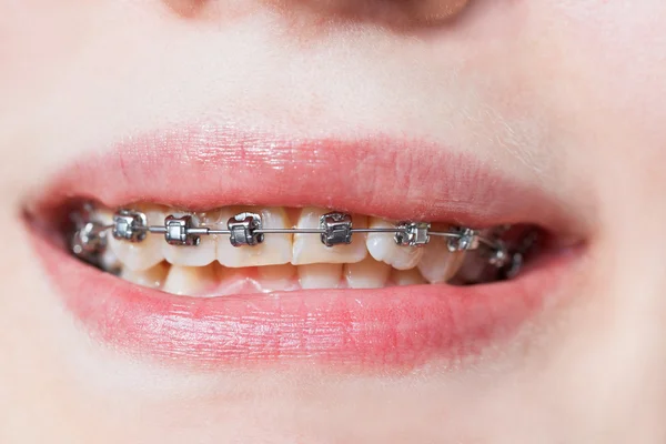 Front view of dental braces on teeth of upper jaw — Stock Photo, Image