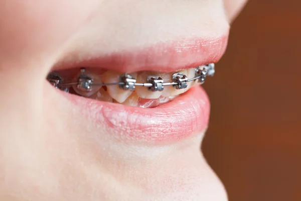 Dental braces on teeth of upper jaw close up — Stock Photo, Image