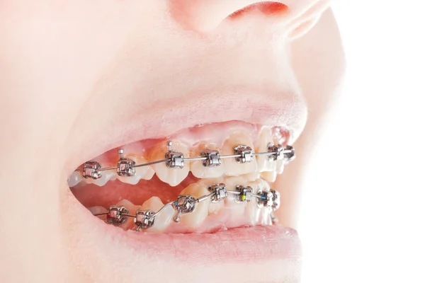 Dental braces on teeth close up — Stock Photo, Image