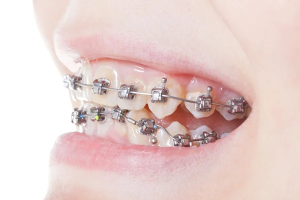 Side view of dental braces on teeth close up — Stock Photo, Image