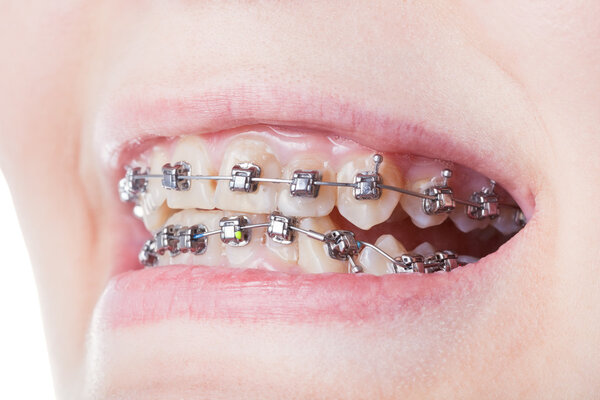 dental steel brackets on teeth close up