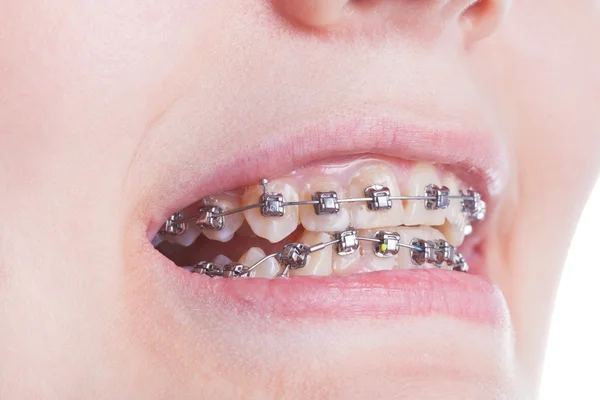 Ортодонтичні брекети на зубах крупним планом — стокове фото
