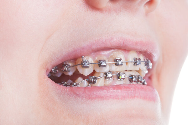 orthodontic braces on teeth close up