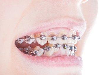 dental brackets on teeth close up clipart