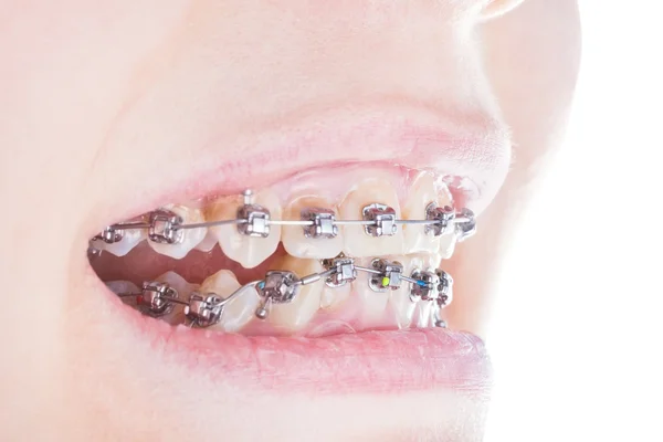 Зубні кронштейни на зубах крупним планом — стокове фото