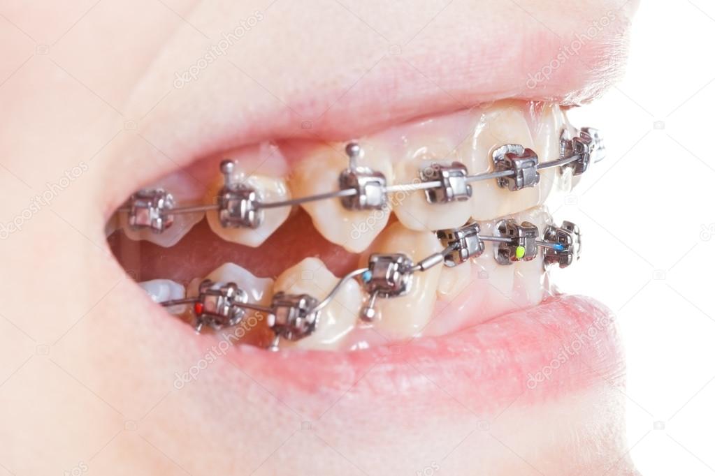 side view of dental brackets on teeth close up stock photo