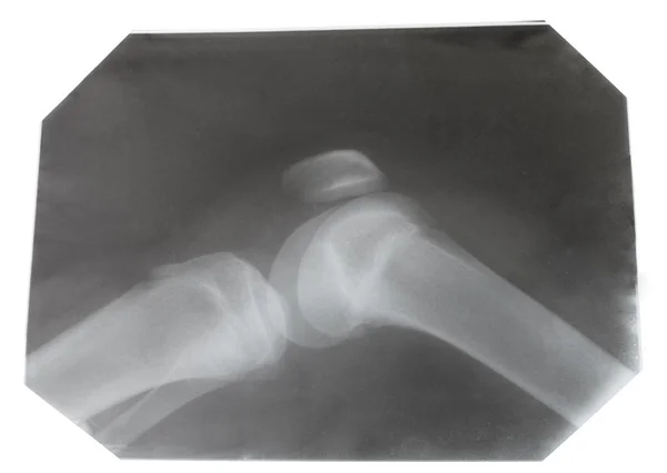 Imagen radiográfica de la articulación de la rodilla humana —  Fotos de Stock