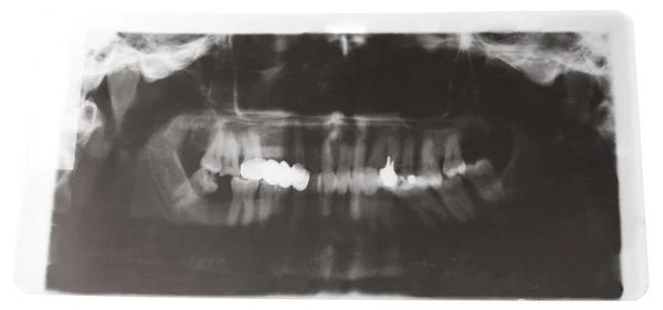 Imagem de raio-X de mandíbulas humanas com coroa dental — Fotografia de Stock