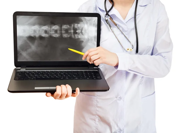 Nurse points on computer laptop with spinal column — Stock Photo, Image