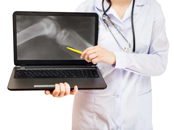 Nurse points on computer laptop with knee joint — Stock Photo, Image