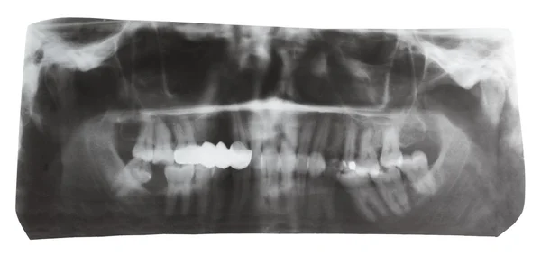 Imagem radiológica dental de mandíbulas humanas isoladas — Fotografia de Stock