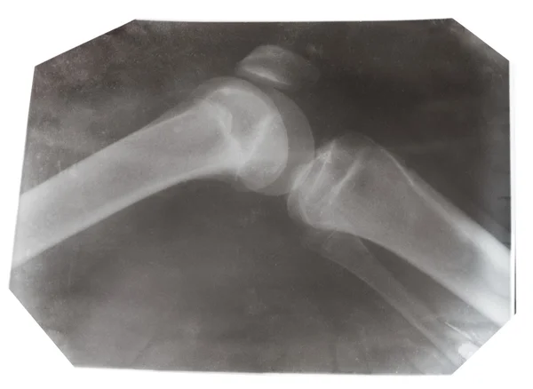 X-ray photo of human knee joint isolated — Stock Photo, Image