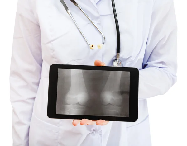 Nurse holds tablet pc with two human knee-joints — Stock Photo, Image