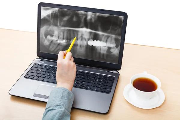 Dentist analyzes X-ray picture of jaws on laptop — Stock Photo, Image