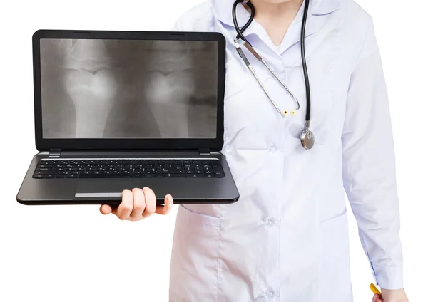 Nurse holds computer laptop with human knee joint — Stock Photo, Image