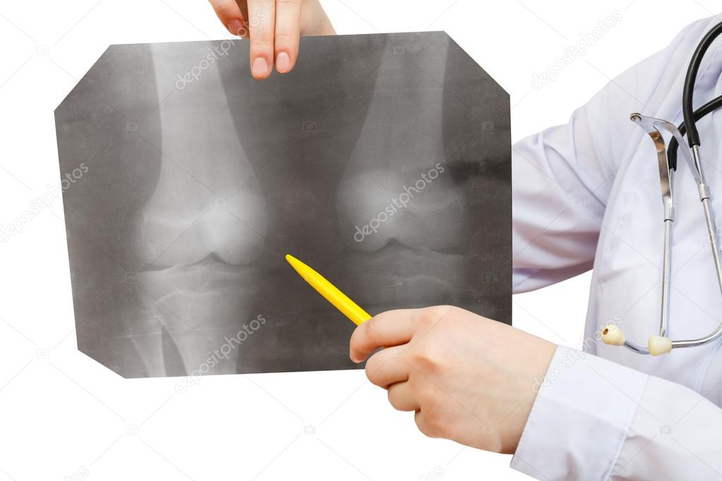Nurse points X-ray picture with human knee joint