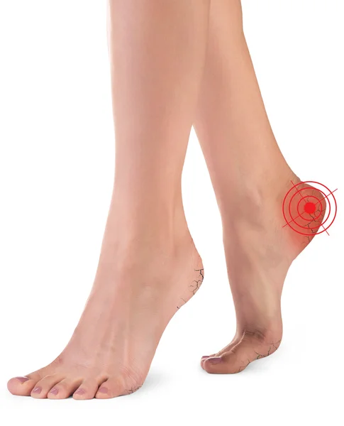 Vrouwelijke benen met scheuren — Stockfoto