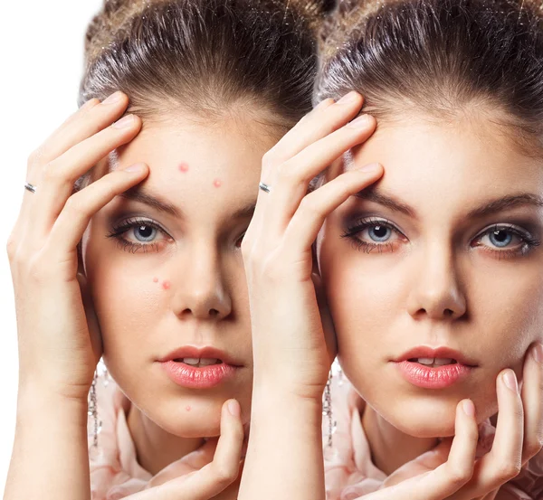 Kobieta z problem ze skórą na twarzy — Zdjęcie stockowe