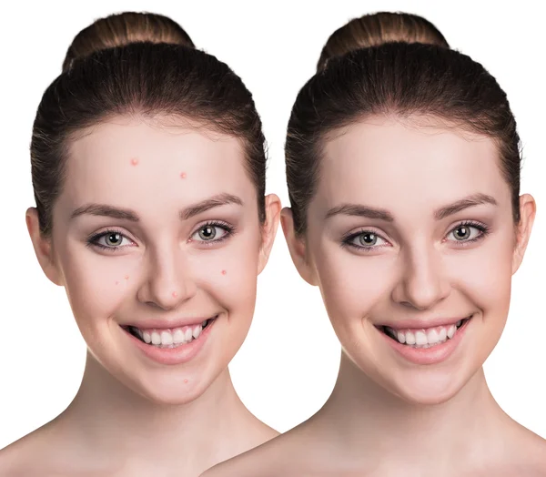 Woman with problem skin on her face — Stock Photo, Image