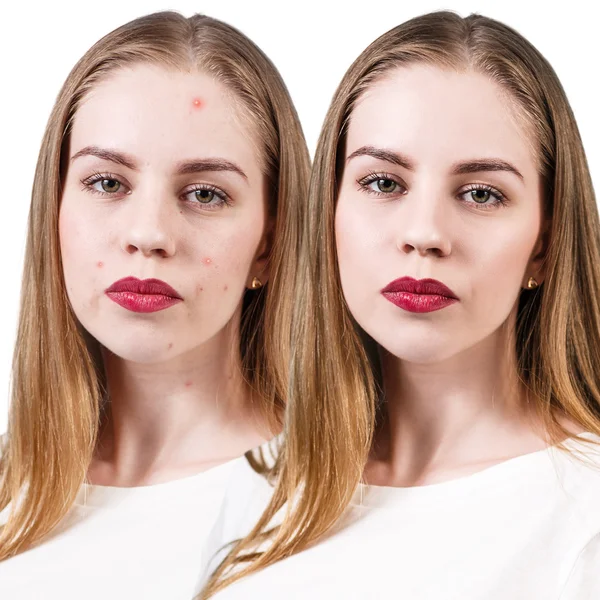 Žena s problémem kůže na tváři — Stock fotografie
