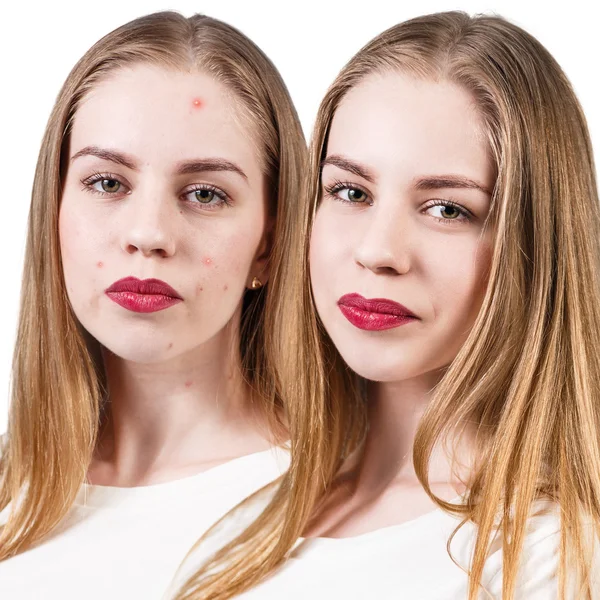 Vrouw met probleem huid op haar gezicht — Stockfoto