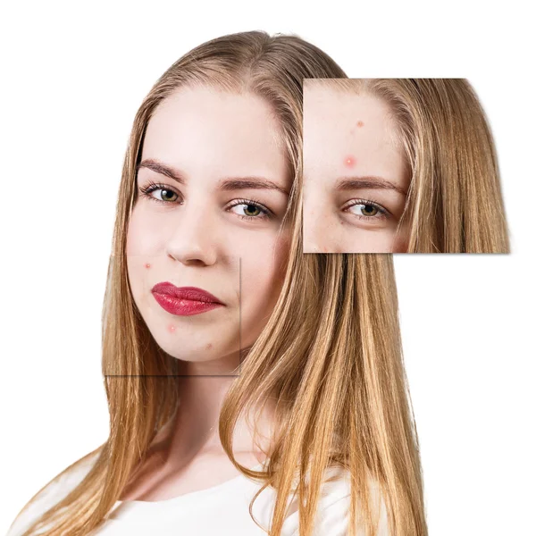 Frames with problem skin on woman face — Stock Photo, Image