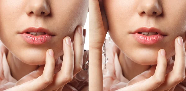 Levres Gercees Images Libres De Droit Photos De Levres Gercees Depositphotos