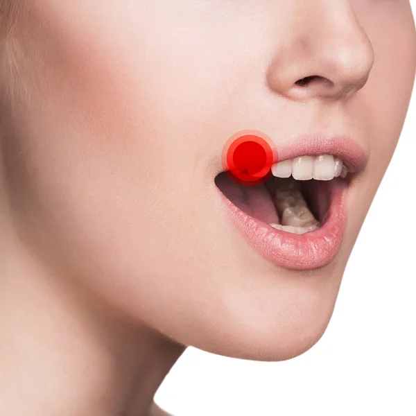 Sore on the female lips — Stock Photo, Image