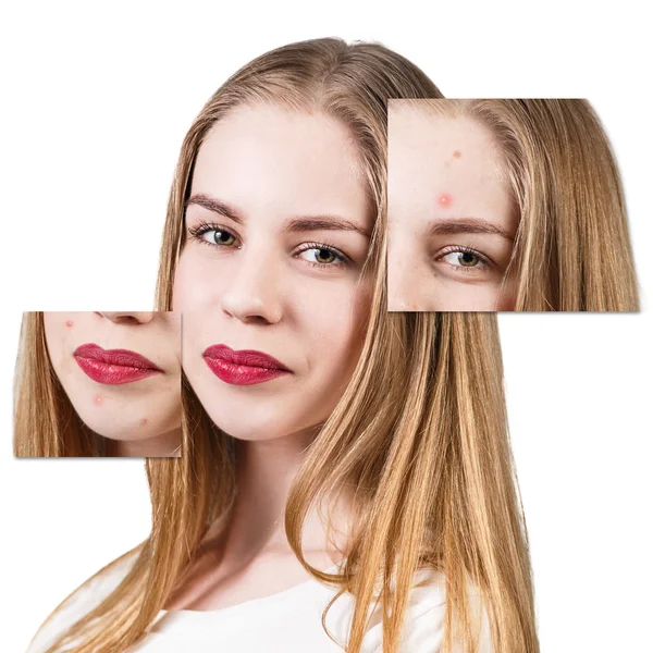 Frames with problem skin on woman face — Stock Photo, Image